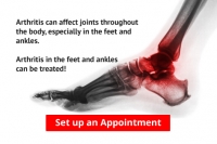 Arthritis Can Cause Pain in the Feet and Ankles